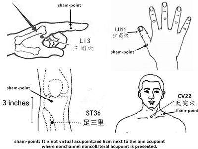 Acute Effect of Transcutaneous Electroacupuncture on Globus Pharyngeus: A Randomized, Single-Blind, Crossover Trial